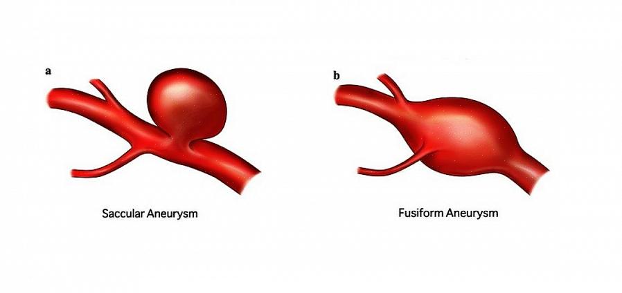 מפרצת תוך גולגולתית - Aneurysma In Het Hoofd Symptomen