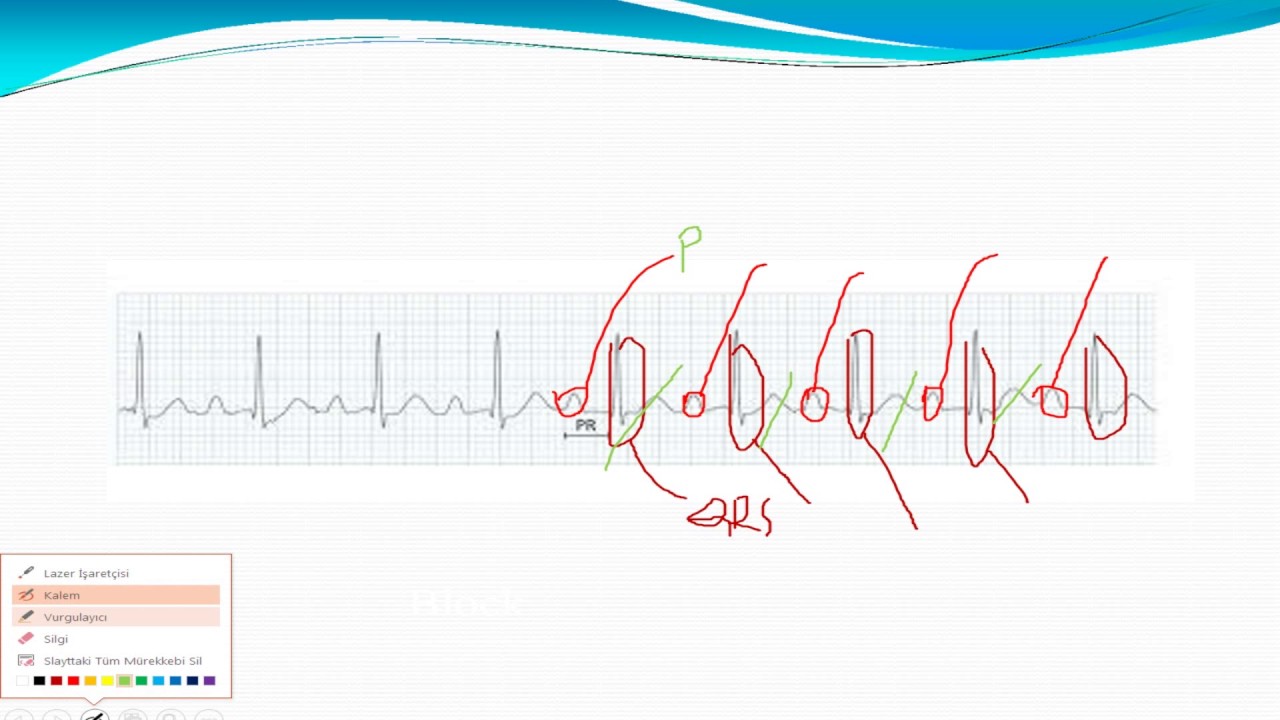 1. derece AV BLOK, EKG, PRATİK EKG - YouTube - 1e Graads Av Blok Ecg
