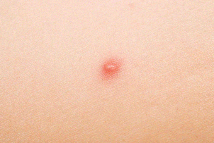 20 Ways to Get Rid of Zits and Prevent Breakouts - Zit Er Veel Zout In Ijs