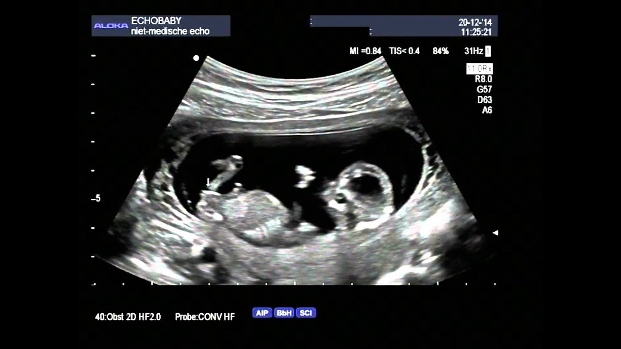 2D echo 13 weken geslachtsbepaling, met ingesproken uitleg - YouTube - Hartafwijking Baby 20 Weken Echo
