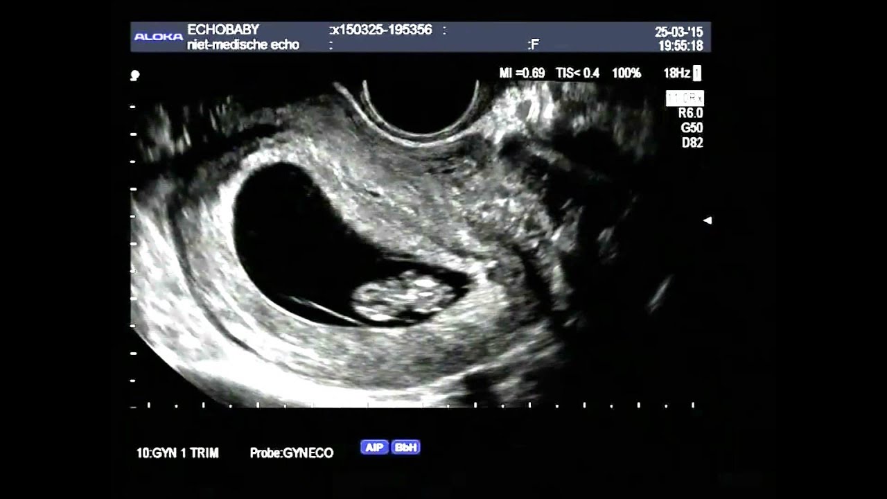 Hartafwijking Baby 20 Weken Echo