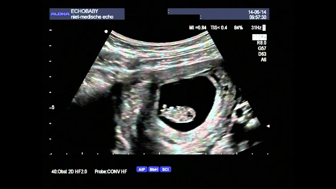 2D Echo 8 Weken Zwanger - YouTube - Baby 3 Weken Slaapt 8 Uur Door