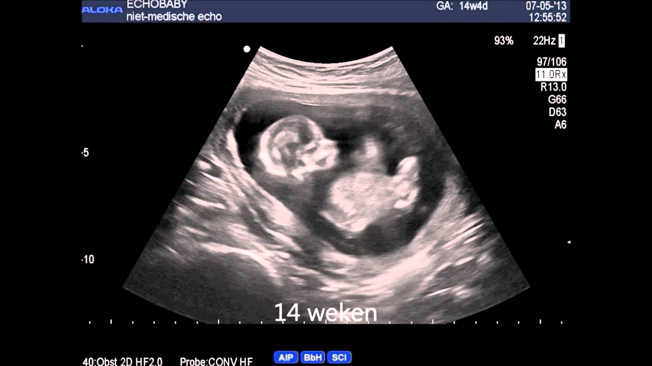 2D-echo van 6 tot 26 weken zwangerschap - YouTube - Wat Ziet Een Baby Van 7 Weken