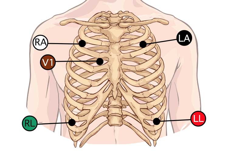 3 Lead Ecg Monitor Circuit Diagram - Druk Op Borst En Kortademig