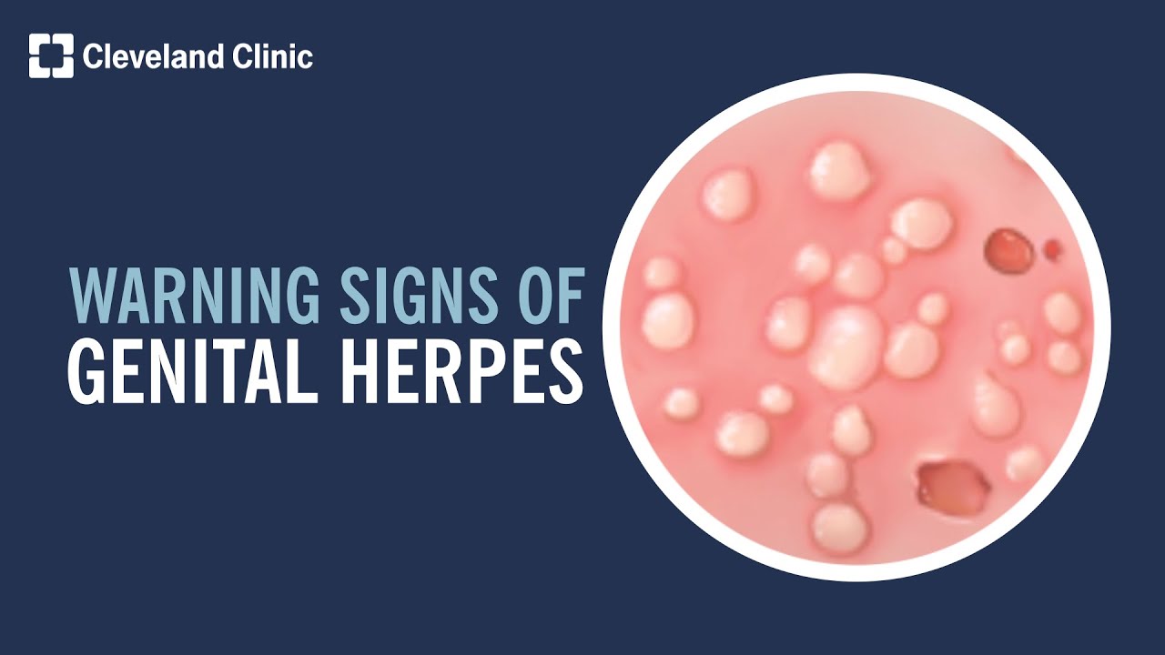 5 Warning Signs of Genital Herpes - YouTube - Hoe Lang Is Herpes Besmettelijk