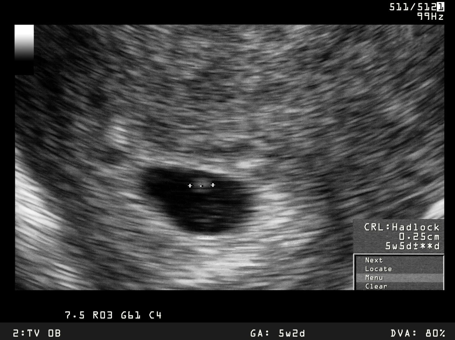 6. Schwangerschaftswoche (6. SSW): Alles zur Entwicklung des Babys in - Zwanger 6 Weken Geen Symptomen