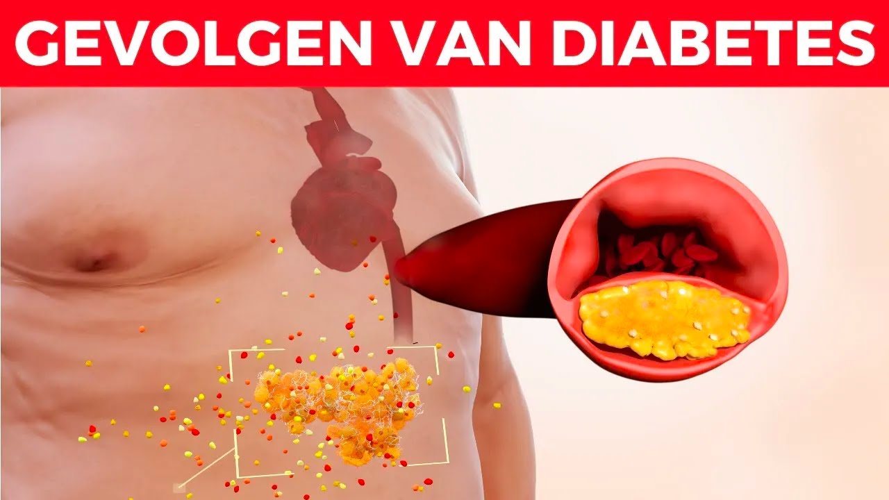 Welke Types Diabetes Zijn Er