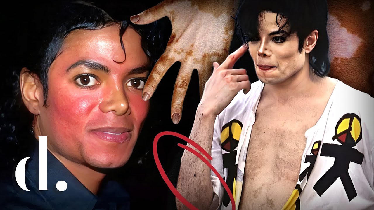 Wat Voor Ziekte Had Michael Jackson