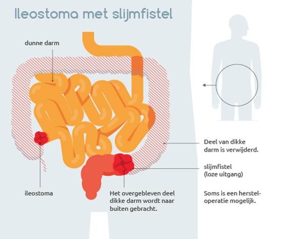 Aanleg ileostoma - Hoe Ziet Een Stoma Eruit