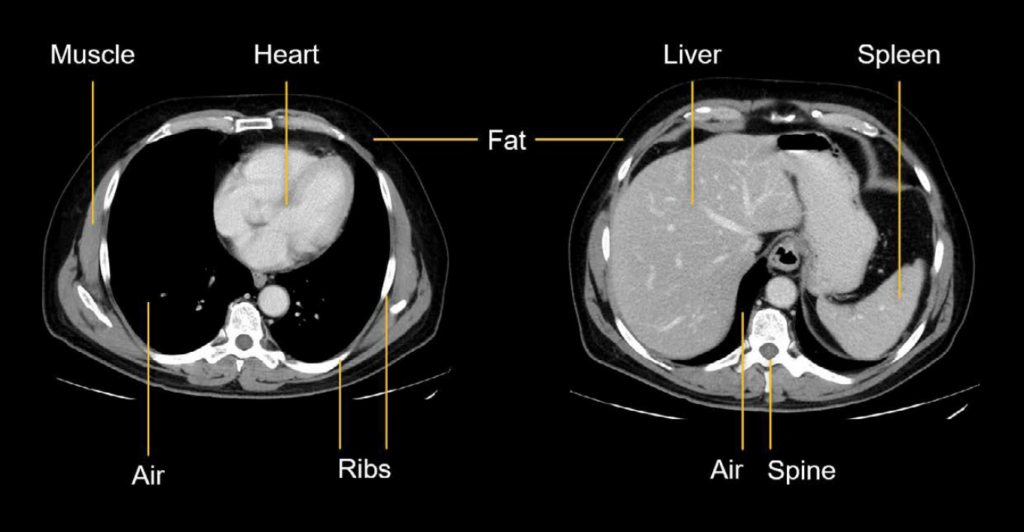 Abdominal CT: Basics • LITFL • Radiology library - Ct Scan Van Het Hoofd