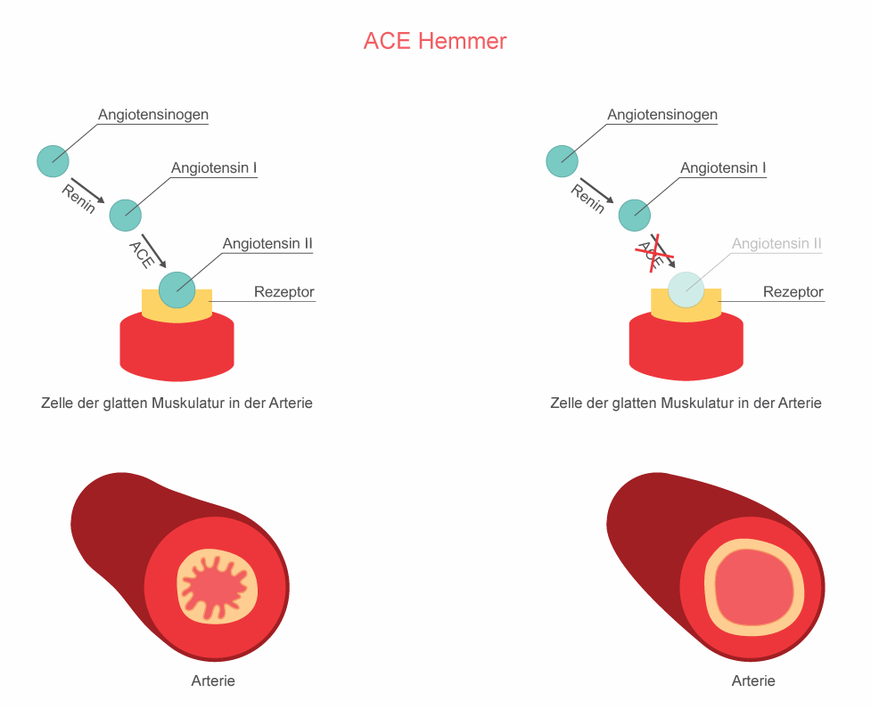 ACE-Hemmer | Herzlexikon | BlutdruckDaten - Wat Is Een Ace Remmer