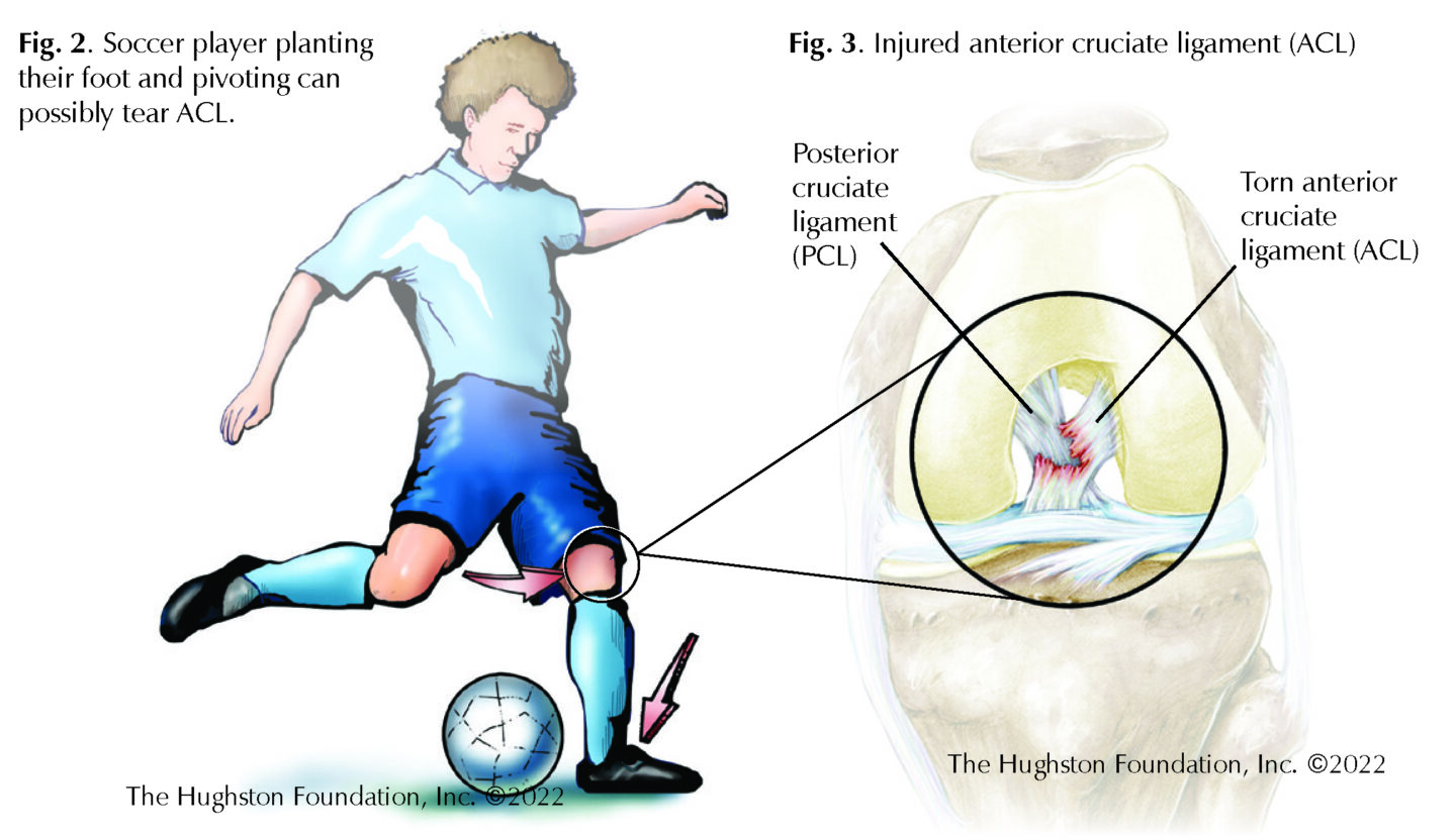 Wat Is Een Acl Injury