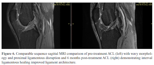 ACL Ruptured - All You Need to Know - Centeno-Schultz Clinic - Wat Is Een Acl Blessure