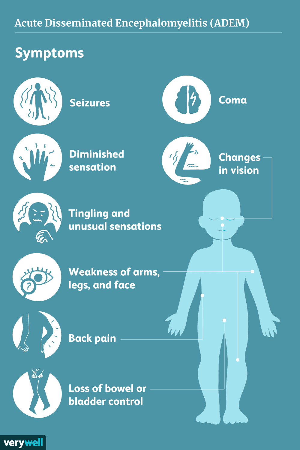 Acute Disseminated Encephalomyelitis (ADEM): Symptoms, Causes - Adem In Adem Uit Jochem Myjer