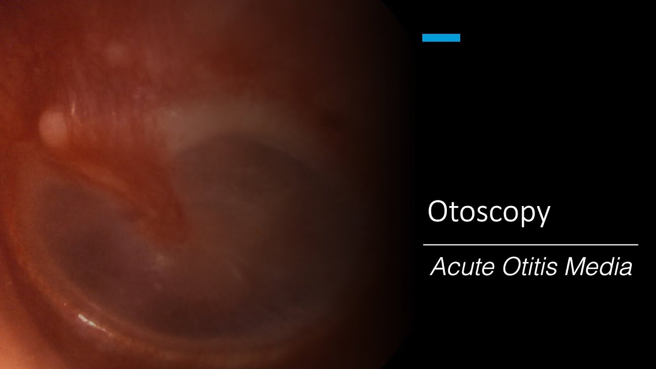 Acute Otitis Media: Otoscopy - YouTube - Otitis Media Met Effusie Volwassenen Nhg