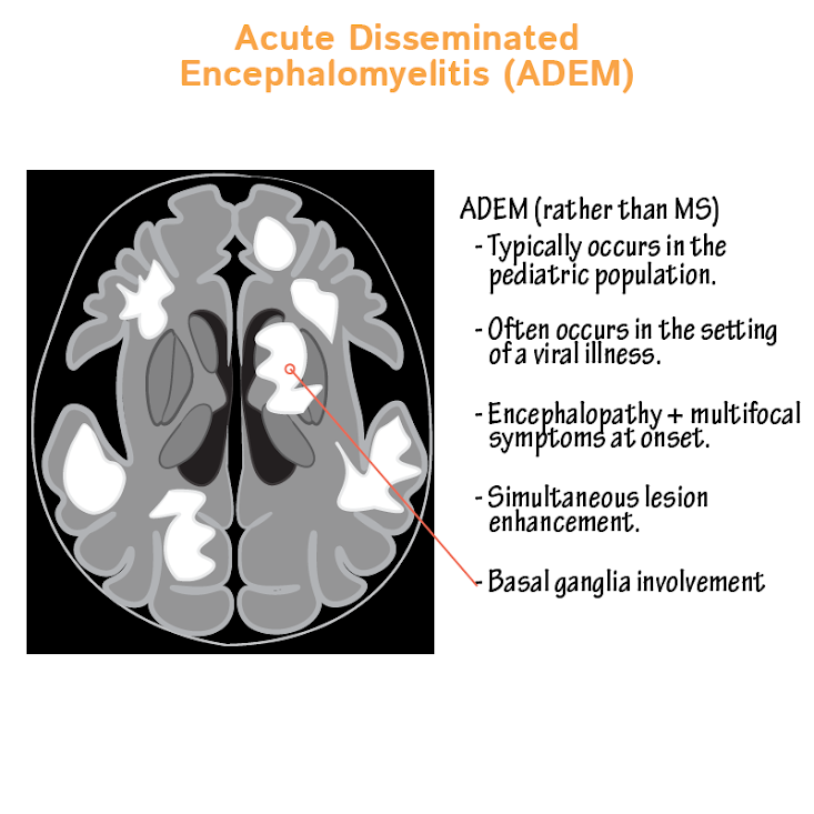 ADEM (acute disseminated encephalomyelitis),what to know? - Adem In Adem Uit Jochem Myjer