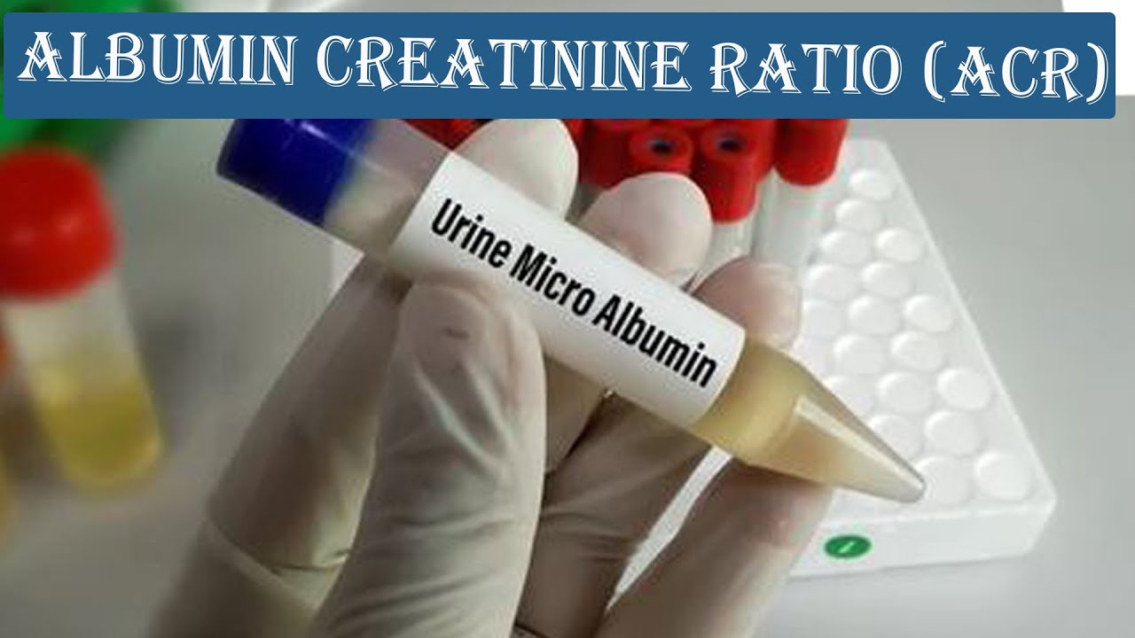 Albumin Creatinine Ratio (ACR) // How to Calculation ACR ??? with - Creatinine In Urine Te Laag