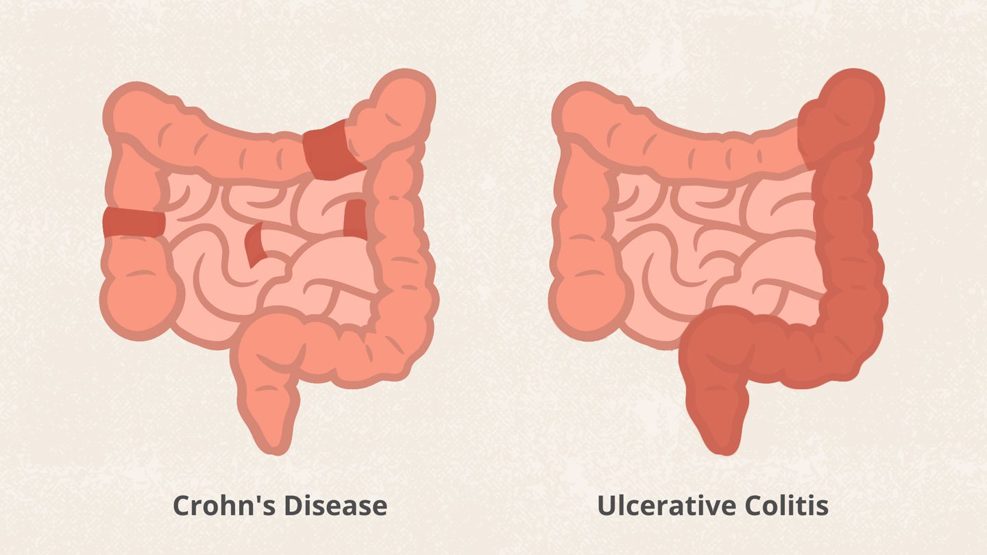 All Crohns Disease Articles | Christ Memorial - Ziekte Van Crohn En Zwangerschap