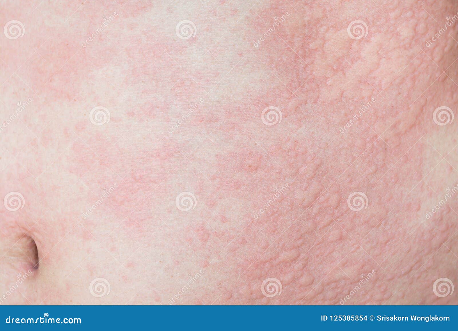 Allergic Reaction Rash On Body - Allergische Reactie Huid Rode Vlekken