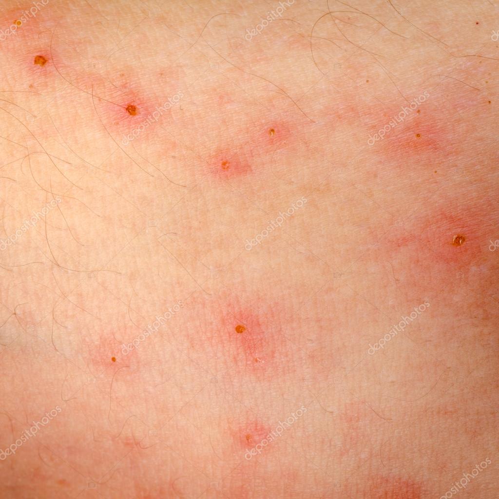 Allergische uitslag dermatitis eczeem-huid ⬇ Stockfoto, rechtenvrije - Huid Koud Klam En Zweten Bloeddruk