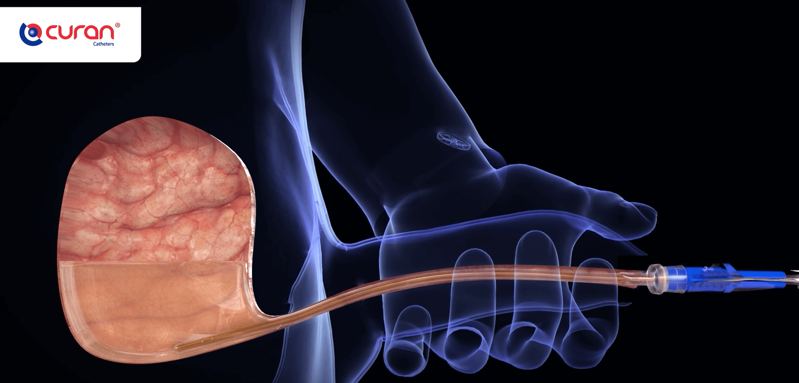 Alles over zelfkatheterisatie voor een man - Curan Medical - Welke Vormen Van Katheterisatie Hebben De Voorkeur