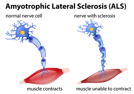 ALS (Amyotrophic Lateral Sclerosis) | Brain Institute | OHSU - Als Je Niet Kan Slapen In De Nacht Lyrics