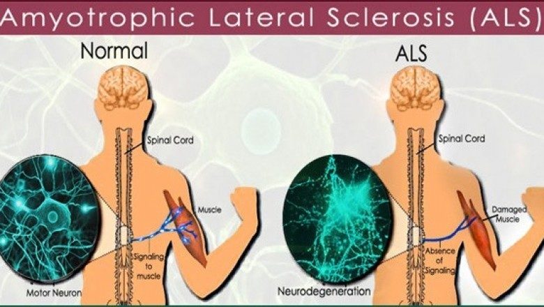 ALS diagnosis and treatment - Als Eerst Of Als Eerste