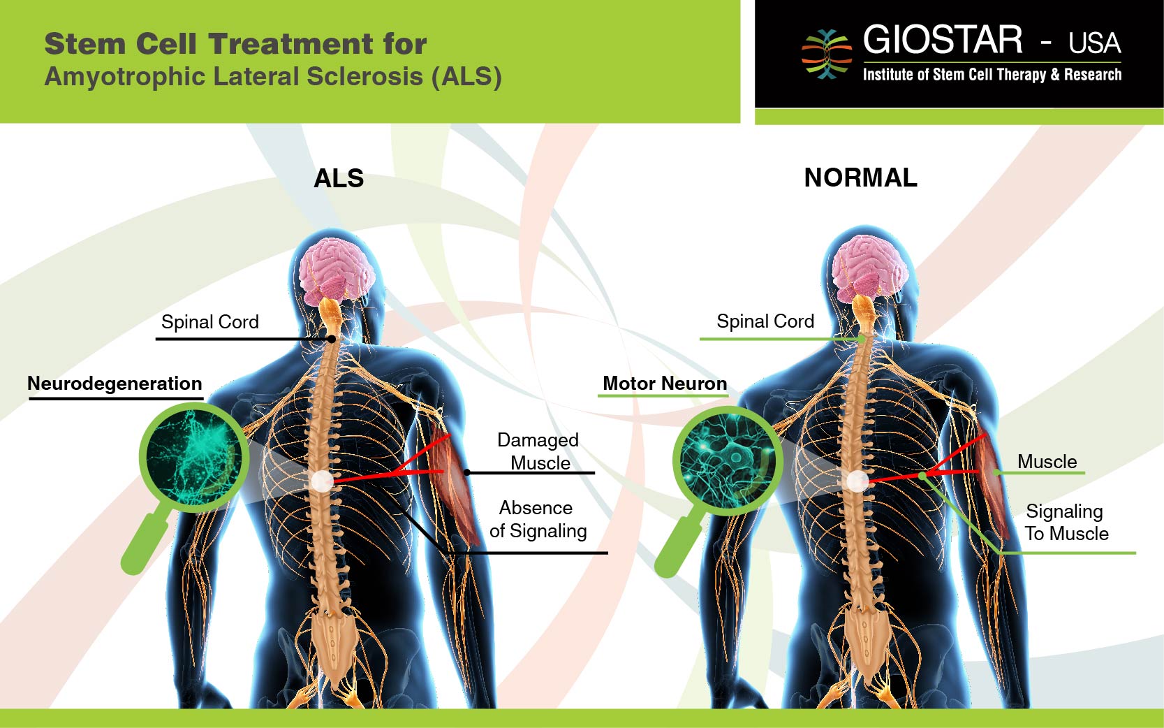 #ALS Treatment India, Stem Cell Treatment for Amyotrophic Lateral - Als Eerst Of Als Eerste