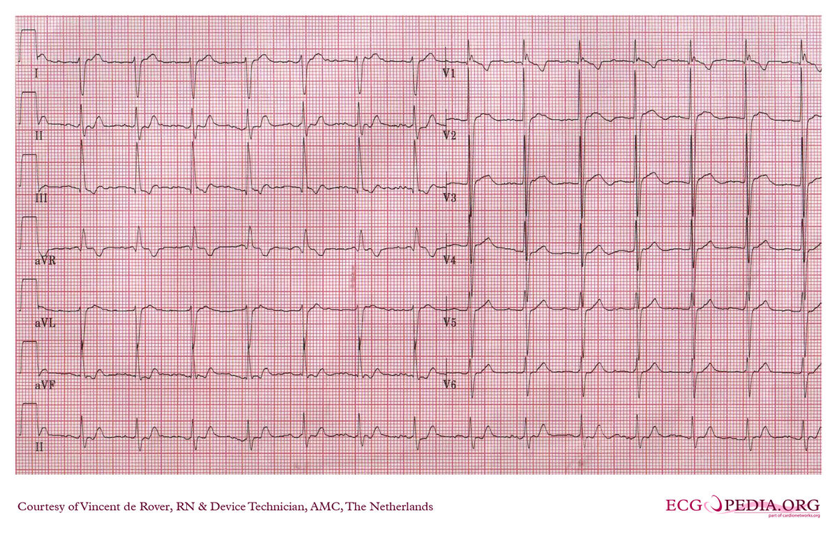 AMC Case 144 - ECGpedia - Transpositie Van De Grote Vaten