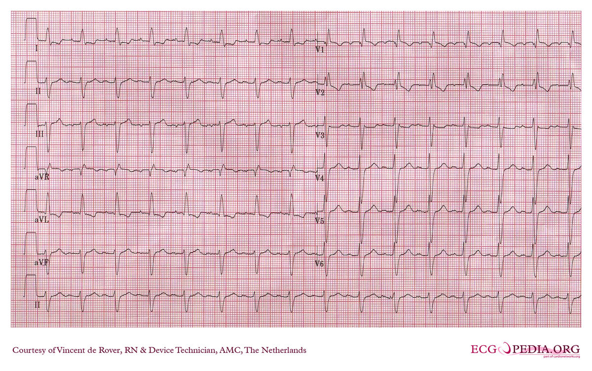 AMC Case 63 - ECGpedia - 1e Graads Av Blok Behandeling
