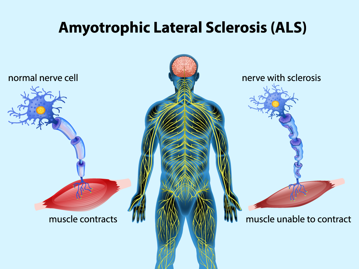 Amyotrophic lateral sclerosis (ALS) - Als De Ene Blinde De Andere Leidt