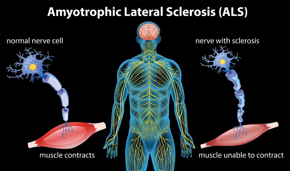 Amyotrophic Lateral Sclerosis (ALS) | Nature's Way MedicineNature's Way - Als Iets Een Keer Gebeurt
