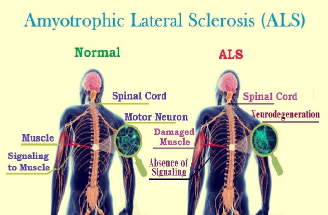Amyotrophic Lateral Sclerosis - Diagnosis and Treatment | Care Tips for - Als Iets Een Keer Gebeurt