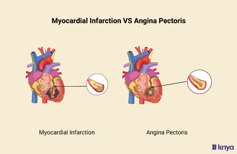 Angina Pectoris Vs Myocardial Infarction | Key Differences – Knya - Verschil Hartinfarct En Acuut Coronair Syndroom