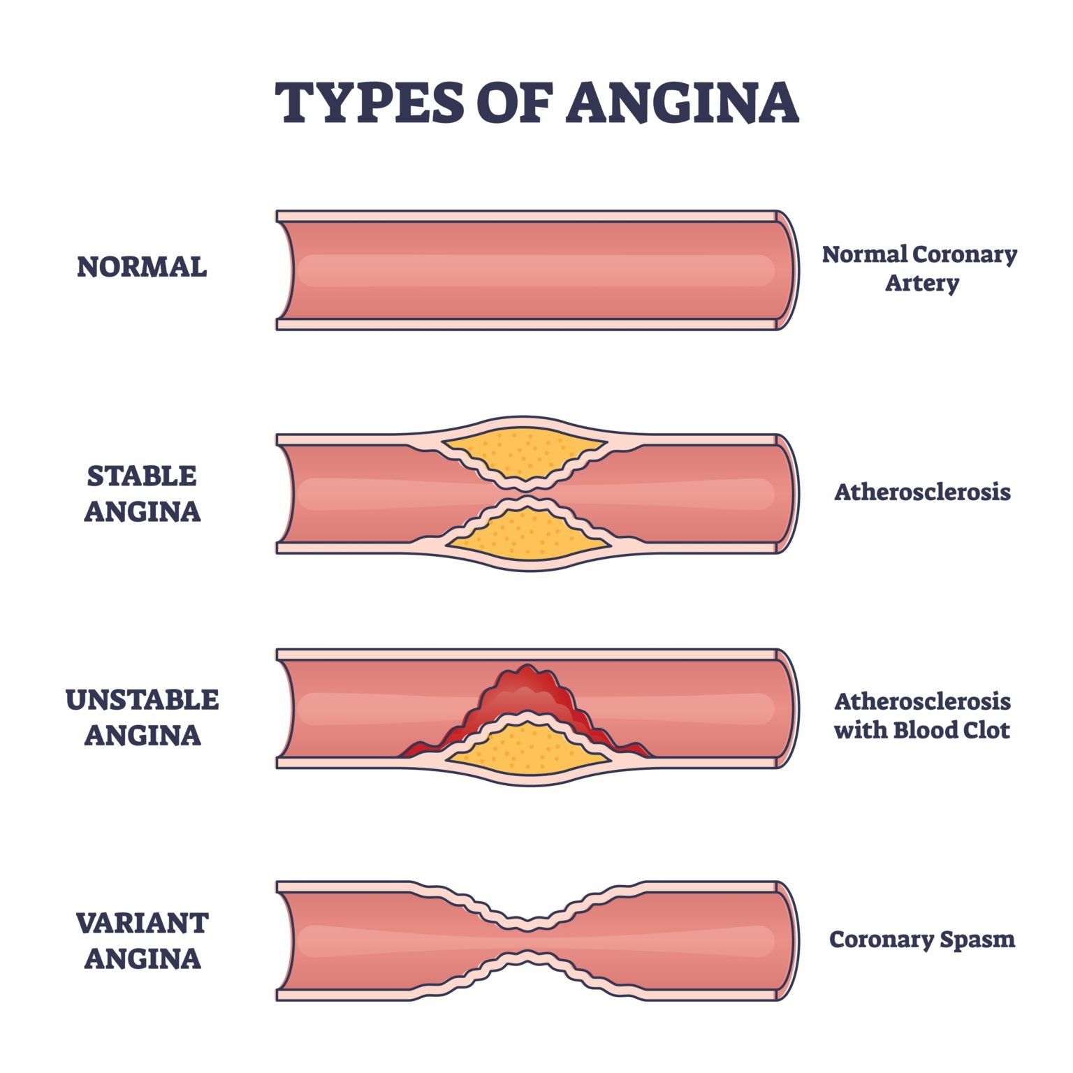 Angina Pectoris Hartaanval Waarschuwingen Symptomen Hartaanval