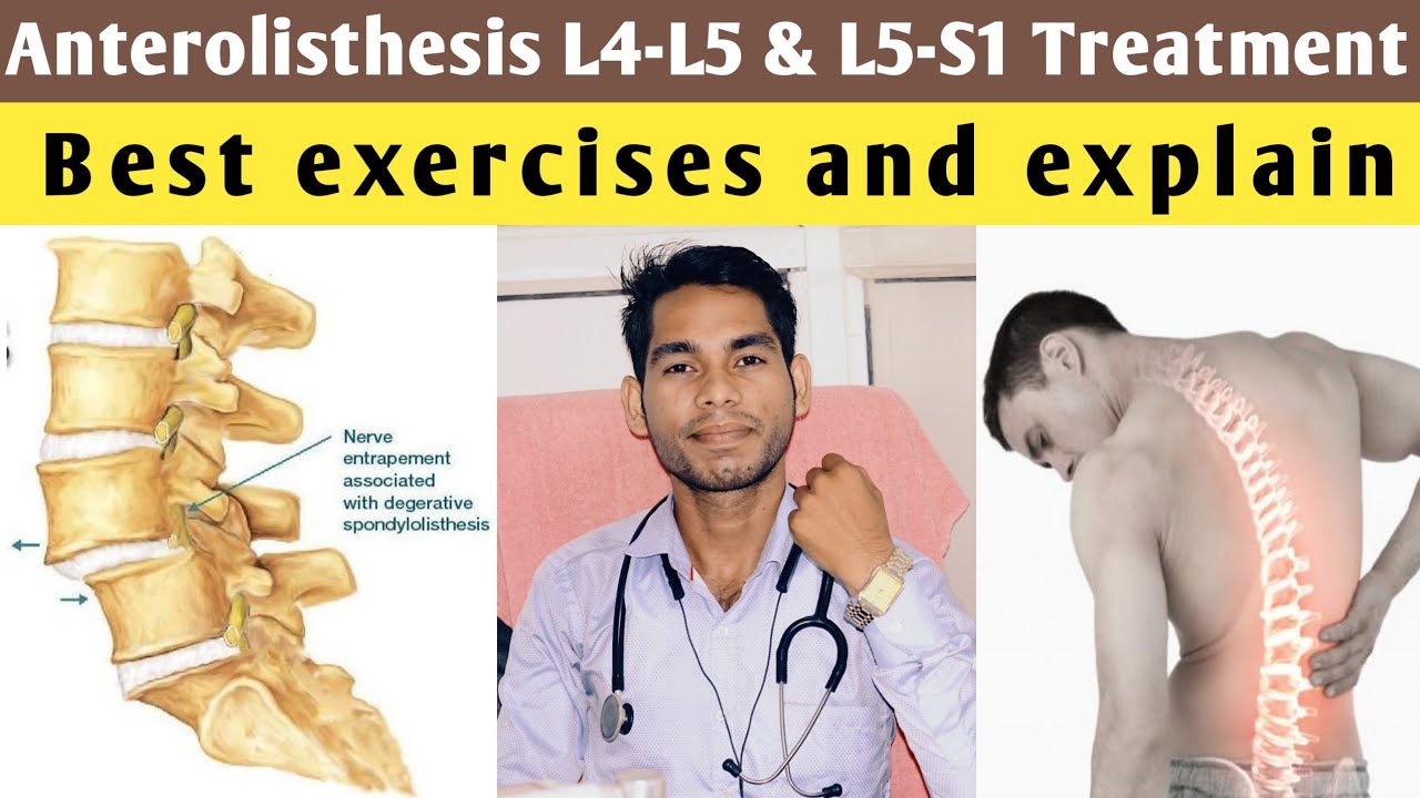 anterolisthesis l5 s1 treatment, anterolisthesis grade 1 treatment - Anterolisthesis Graad 1 Van L4 En L5
