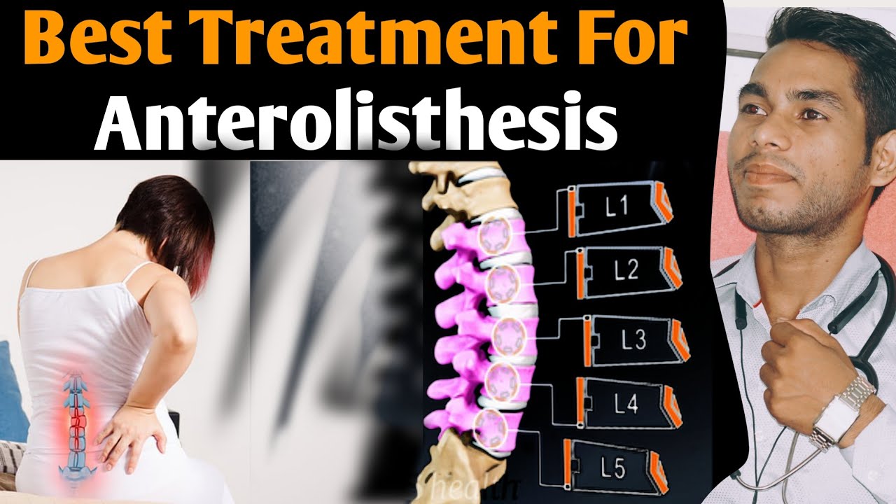 anterolisthesis l5 s1 treatment, Spondylolisthesis grade 1 treatment - Anterolisthesis Graad 1 Van L4 En L5