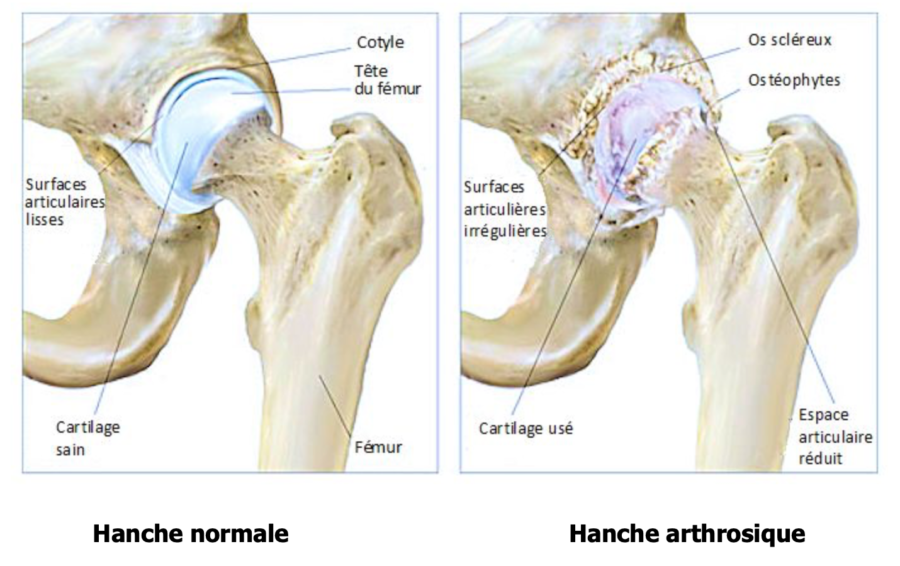 Arthrose de la hanche ou coxarthrose - ISCO - Institut Spécialisé de - Wat Is Het Verschil Tussen Artrose En Coxartrose