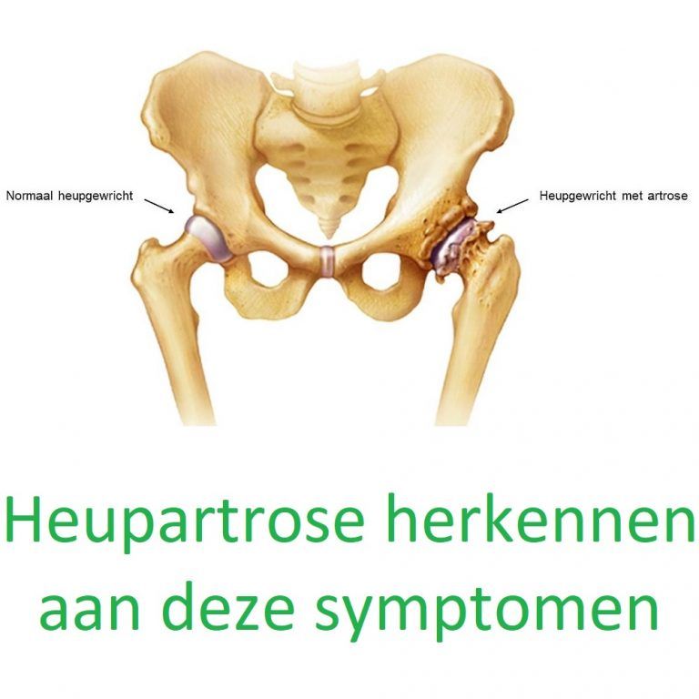 Artrose in de heup behandelen met 6 fysiotherapie oefeningen – Artofit - Artrose Pijn In De Nacht