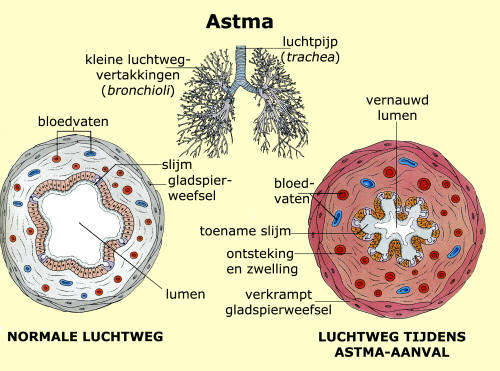 astma, COPD, emfyseem - Leg Uit Welk Gevolg Een Astma-aanval Heeft Voor De Gaswisseling