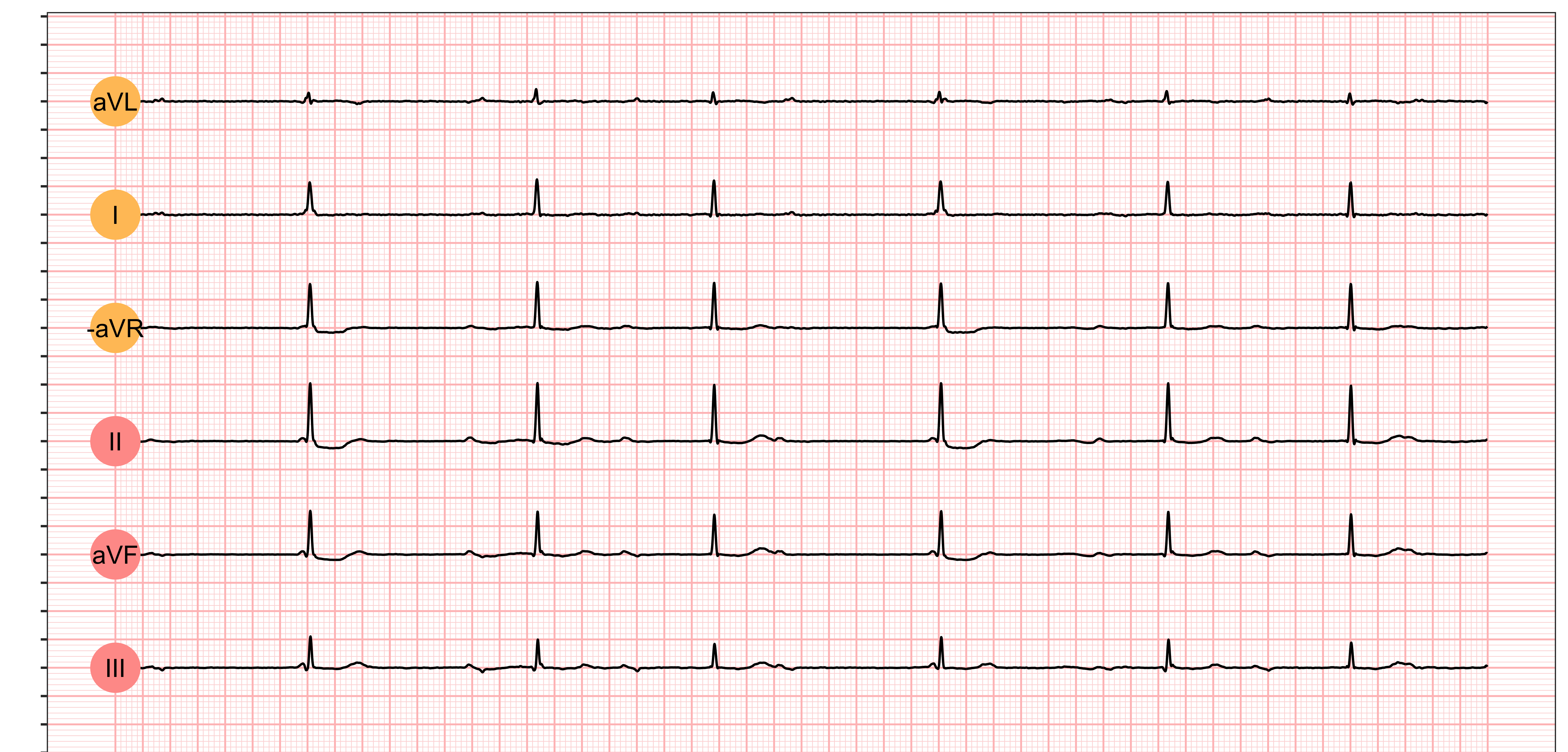 Atrioventricular Block Wikipedia, 58% OFF - 1e Graads Av Blok Behandeling