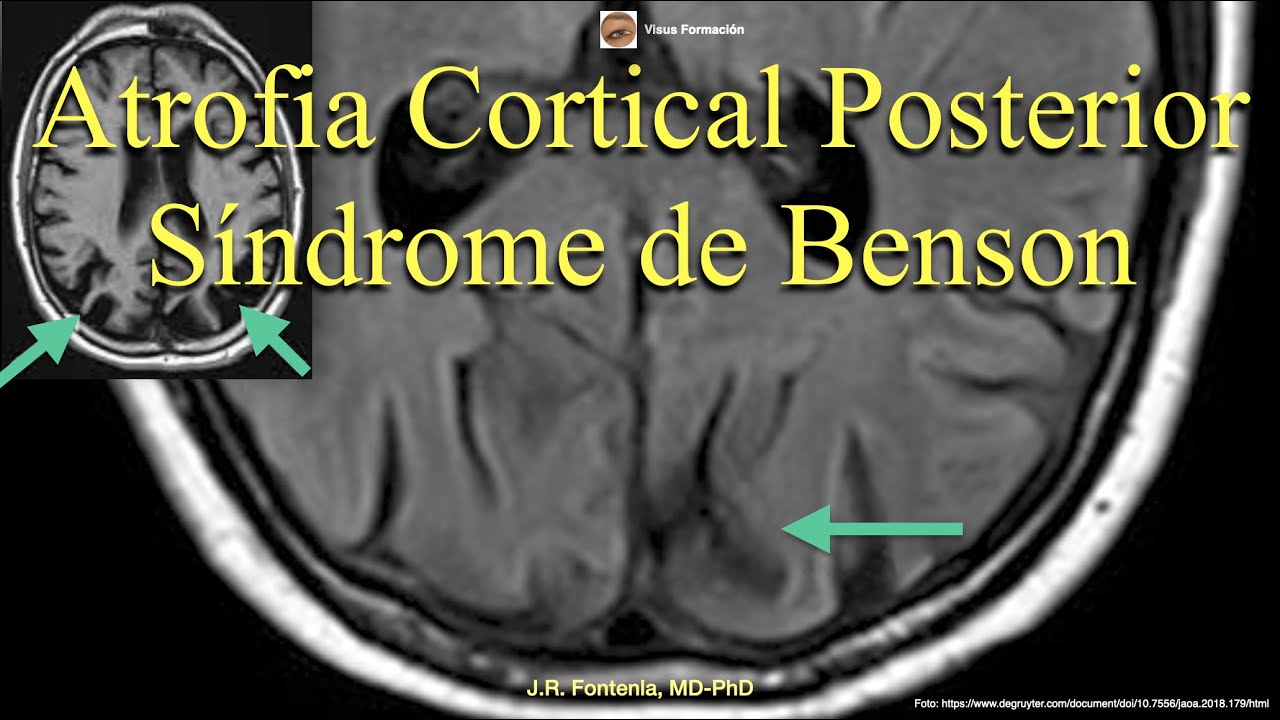 Atrofia Cortical Posterior. Síndrome de Benson - YouTube - Globale Corticale Atrofie Graad 1
