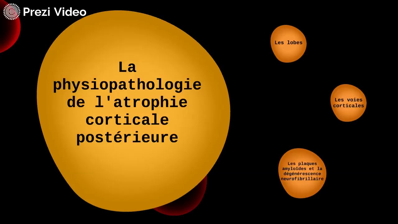 Atrophie corticale postérieure - YouTube - Globale Corticale Atrofie Graad 1