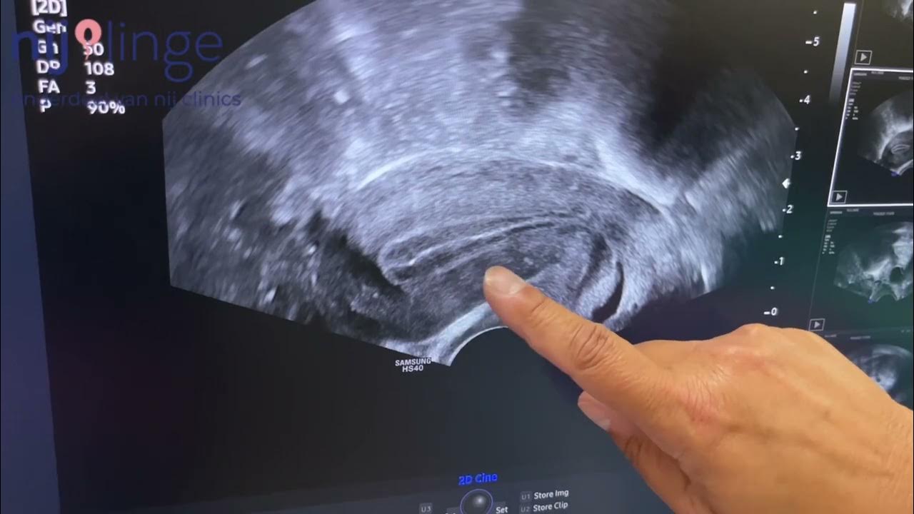 Baarmoederslijmvlies (endometrium) voor de eisprong - YouTube - Eisprong Voor Of Na Menstruatie