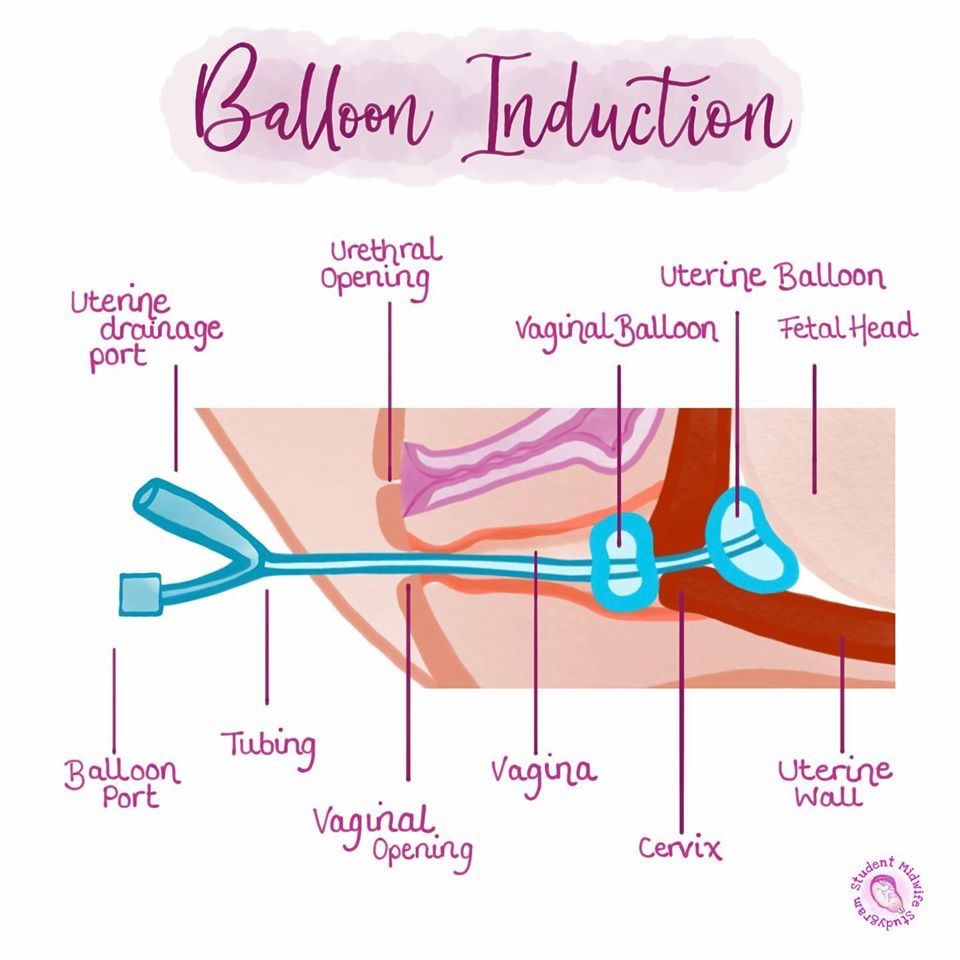 Balloon Catheter Induction Midwifery Student, Student Midwife, Nurse - Wat Is Een Couvelaire Catheter