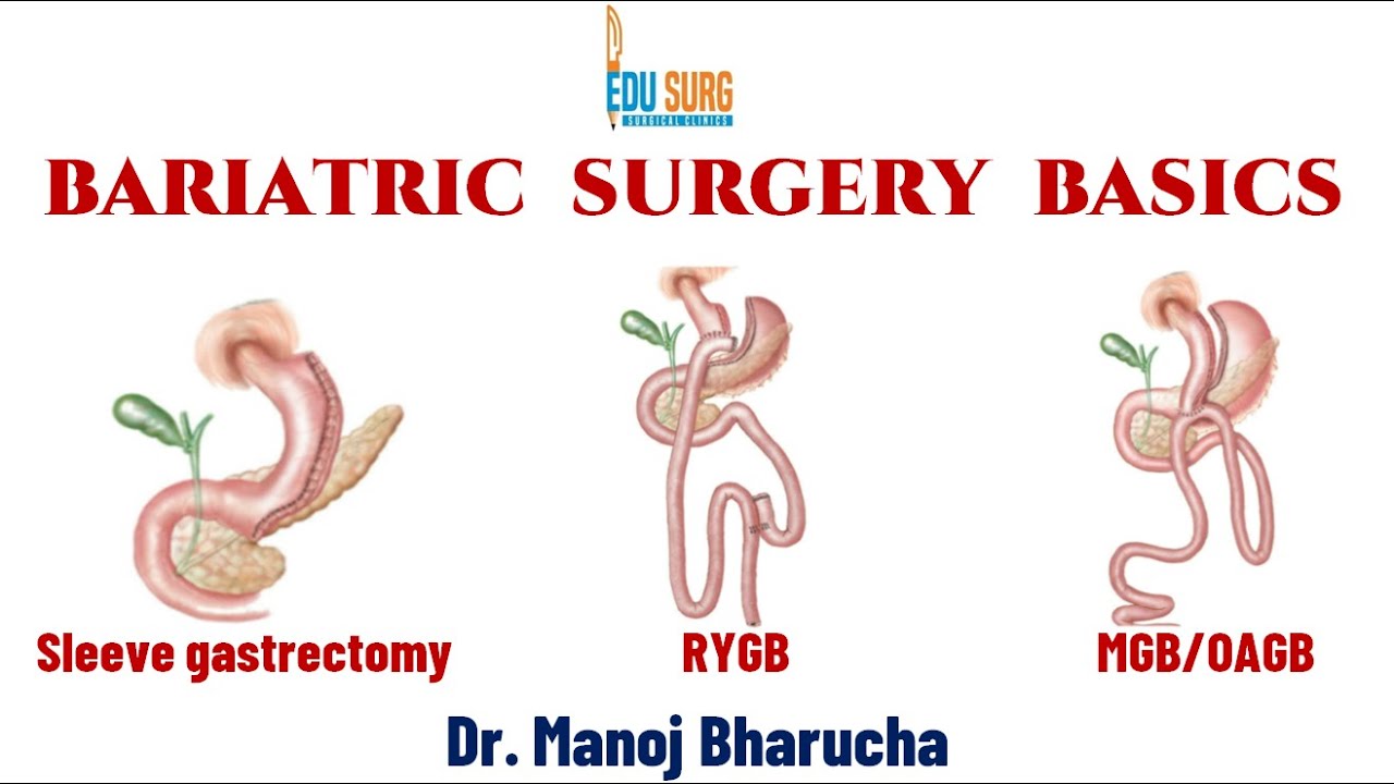 Bariatric surgery basics - Sleeve gastrectomy, mini-gastric bypass - Inwendige Herniatie Na Gastric Bypass