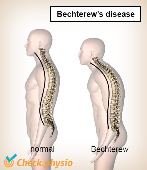 Bechterew's disease | Physio Check - Symptomen Van Ziekte Van Vijver