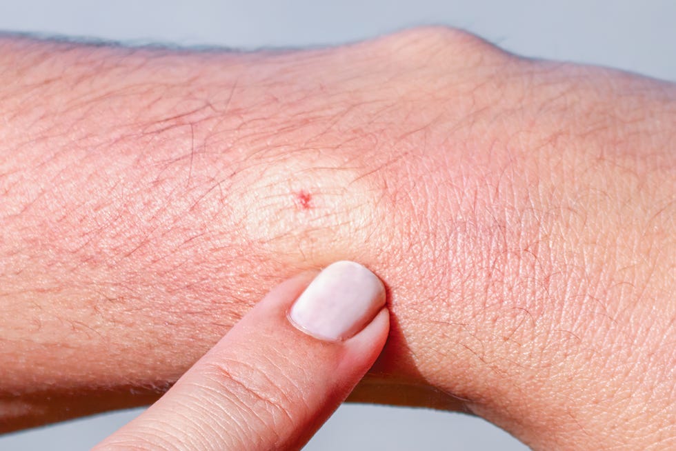 Bee Sting Face Swelling - Hoe Ziet Een Wespensteek Eruit