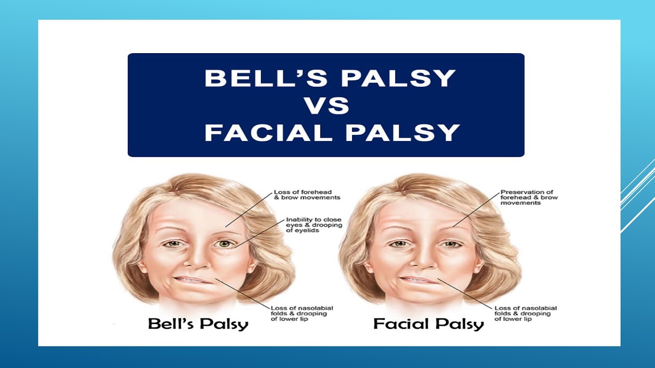 BELL'S PALSY VS FACIAL PALSY - YouTube - Verschil Tussen Tia En Cva
