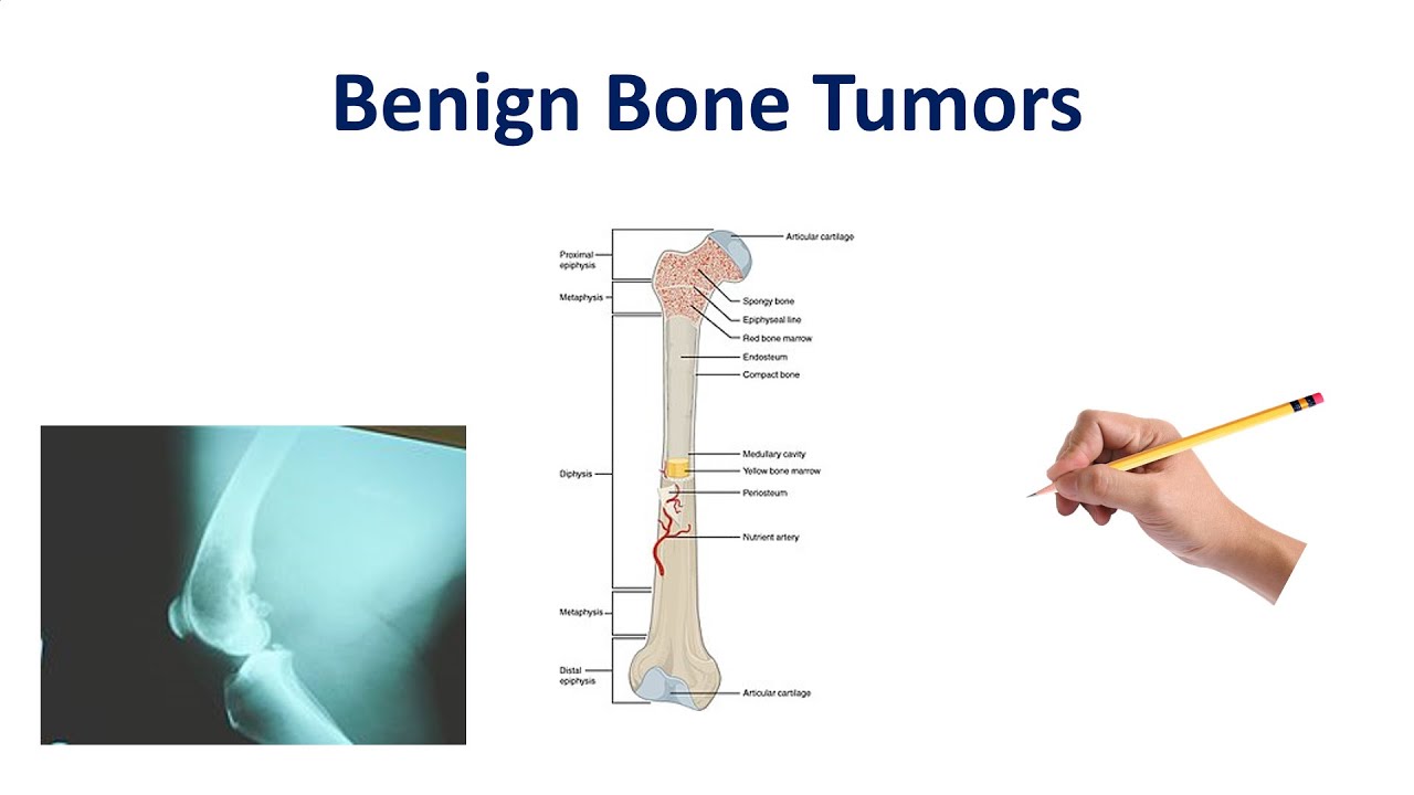 Benign Bone Tumors Made Simple - YouTube - Benigne Tumor In Functioneel Gebied 1-3